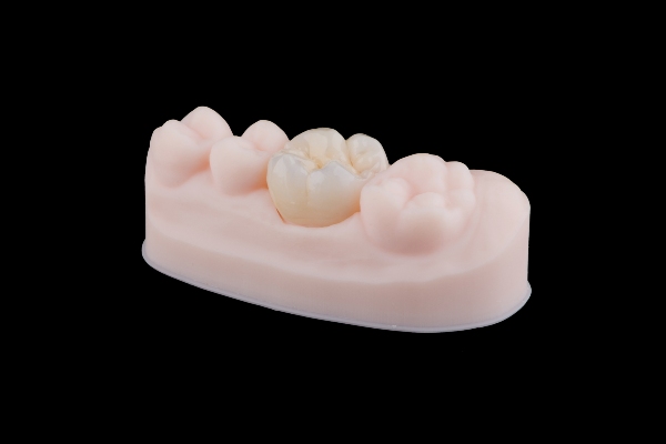 Dental Fillings Vs Dental Crowns: Which Is Better For A Damaged Tooth?