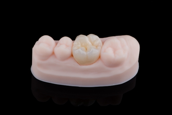 What To Do When Dental Crowns Are Loose